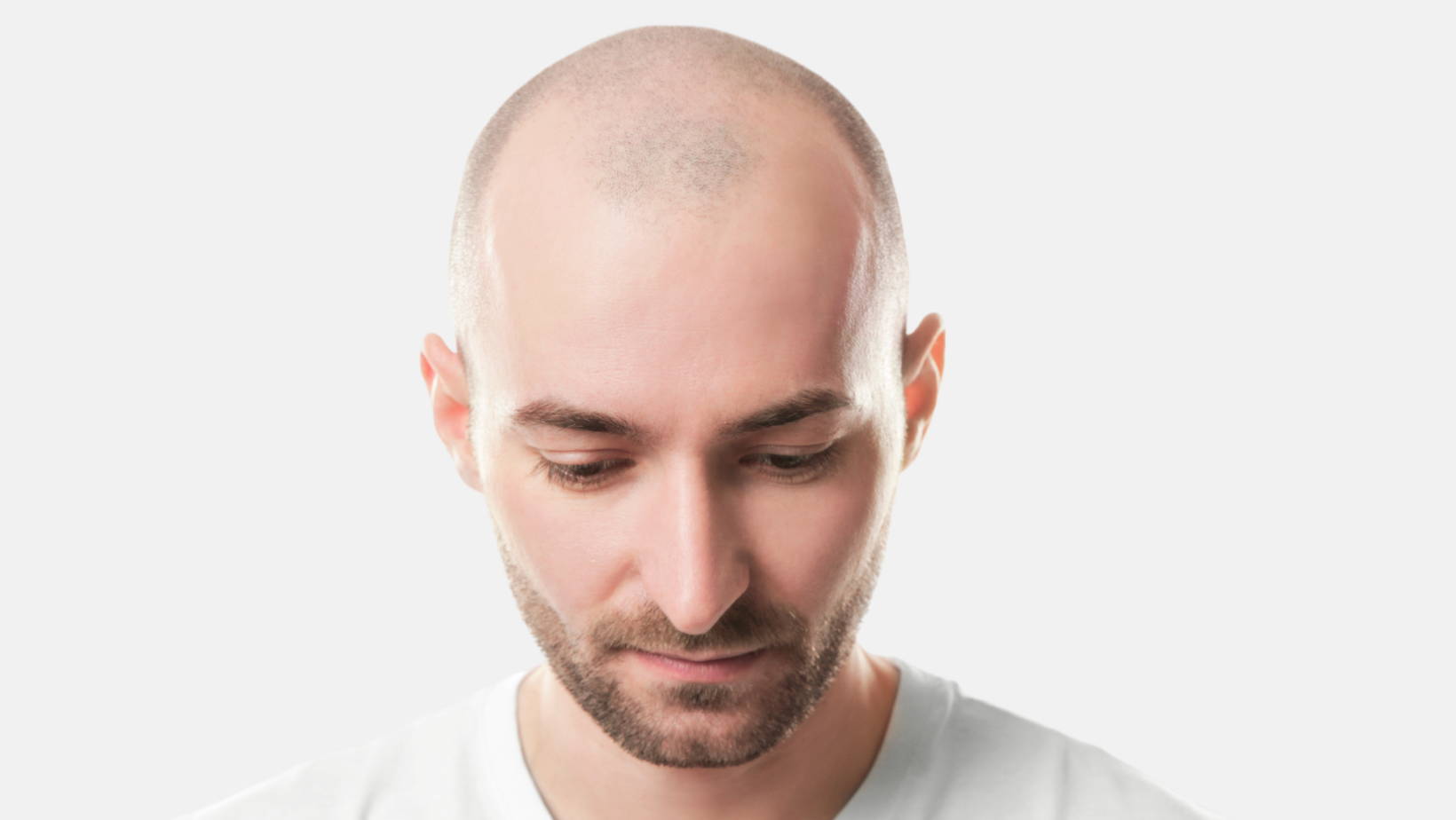 Μεταμόσχευση Μαλλιών ή Σύστημα Μαλλιών; Μάθετε Την Αλήθεια & Τι Ταιριάζει Σε Εσάς