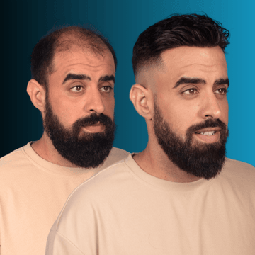 Σύστημα Μαλλιών MACOhair® 1