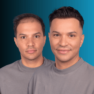 Σύστημα Μαλλιών MACOhair® 4